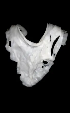 Deformed Collarbone